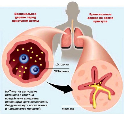 Бронхиальная астма неатопическая - Бронхиальная астма